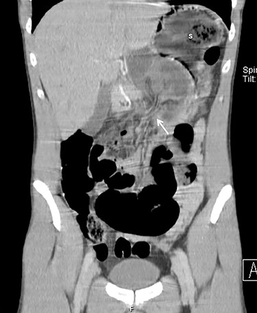 Sagittal CT images with small bowel protruding the gastrocolic omentum (white arrow) to the lesser sac, pushing the stomach (s) upward.