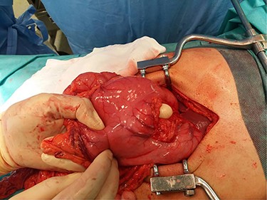 Cephalocaudal orientation from right to left. Hand inserted through the gastrocolic ligament defect and second finger protruding from the gastrohepatic defect.