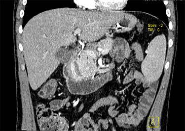 CT scan with contrast, coronal view of the large duodenal mass. Note the polypoid solid mass, in the medial border of the second portion of the duodenum, of approximately 6 cm, enhanced by contrast, slightly heterogeneous and invading the pancreatic head parenchyma. More proximally, in the right lateral border of the first portion of the duodenum, there is an extramural haematoma, well-defined, of approximately 4 × 2 cm, non-enhanced by contrast. Note also a slight dilation of the intrahepatic biliary ducts, and the main bile duct, with a progressive distal narrowing, resulting from compression of the duodenal mass.