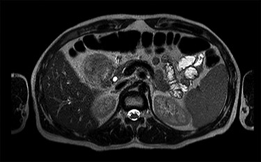 MRI scan—axial view of the large duodenal mass. Note the solid mass, enhanced by paramagnetic contrast, in the medial wall of the duodenum, invading the pancreatic head parenchyma. More proximally, in the first portion of the duodenum, there is a heterogeneous mass, non-enhanced by contrast, suggestive of an intraparietal haematoma.