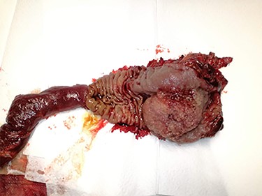 Specimen of the pancreaticoduodenectomy (gallbladder not included in this image). Note the polypoid mass of approximately 6 × 4 cm, with a pink surface, villous area, partially sectioned, invading the head of the pancreas and obstructing de major papilla.