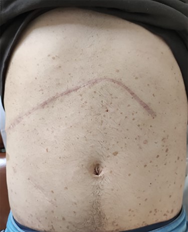 Photograph of the abdomen of this patient, showing the multiple ‘café-au-lait’ spots, on the 8th post-operative month.