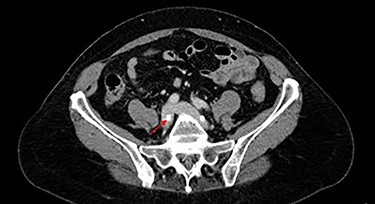 CTV showing right L5 screw (red arrow) indenting right common iliac vein.
