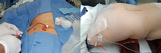 Venous sheath placed through right femoral vein (left). Planned incision line with venous sheath held in place by tape (red arrow) (right).