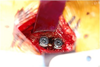 Right rod and screws.