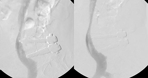 Venogram showing right hardware indenting right common iliac vein and IVC (left). Postoperative venogram displays indentation no longer present after hardware removal (right).