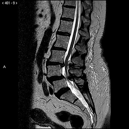 Preoperative T2 sagittal MRI demonstrating a tethered spinal cord continuing caudal to compression at L3–L4 and L4–L5 with the conus medullaris extending to L5–S1.
