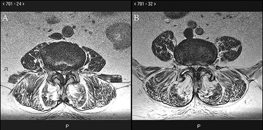 Preoperative axial T2 MRI at the L3–L4 (A) and L4–L5 (B) levels demonstrates ligamentous hypertrophy and central canal stenosis with cord compression.
