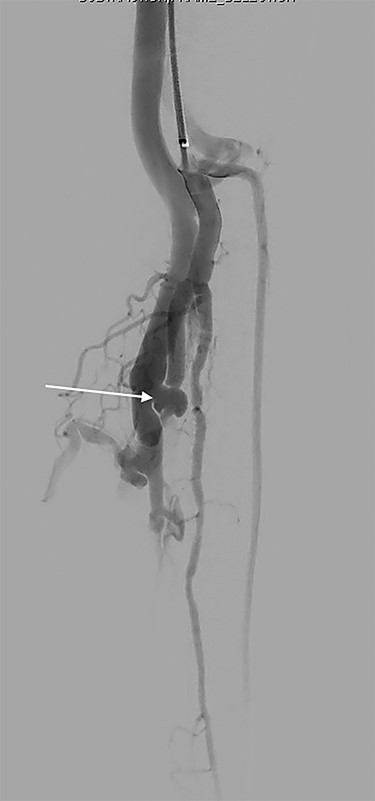 Focused angiography pre-intervention with a catheter positioned at the origin of the tibio-peroneal trunk (TPT). Contrast flows into the TPT, through the AVF (arrow) and into the venous system.