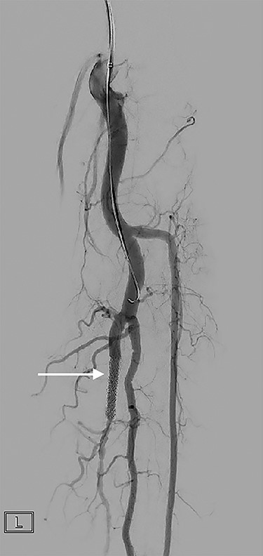 A covered stent (arrow) deployed in the posterior tibial artery occludes flow through the fistula. Contrast flows into the arterial tree without shunting into the venous system.