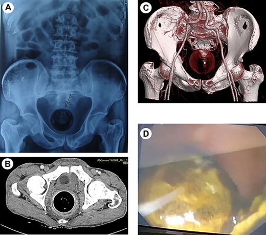 (a) Abdominal X-ray showing round foreign body in the rectum with dilated bowel loops. (b) CECT (axial) abdomen showing impacted foreign body in rectum and (c) the reconstruction image of foreign body in rectum. (d) Rectoscopic image showing rectal mass.