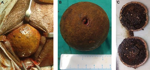 (a) Operative image showing manual disimpaction and evacuation of foreign body through anus under regional anaesthesia. (b and c) Evacuated specimen of bael fruit and cut section showing vegetative material.