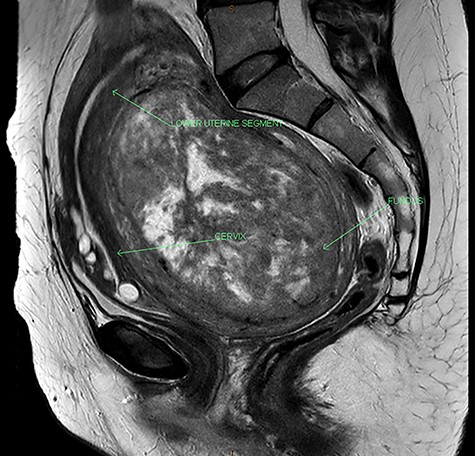 MRI of the pelvis showing acutely retroflexed uterus with the fundus occupying the pouch of Douglas.