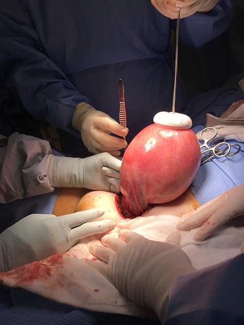 Intraoperative placement of Kiwi® OmniCup on the uterine fundus for ease of uterine manipulation.