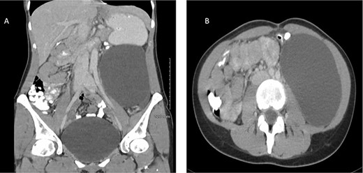 Contrast-enhanced CT of a 32-year-old woman presenting with chronic abdominal pain and a mass in left iliac fossa. The image demonstrates a retroperitoneal space occupying lesion measuring 11 cm in coronal plane (A) and resulting in anterior displacement of the descending colon (B).
