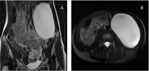 MRI of a 32-year-old woman presenting with chronic abdominal pain and a mass in left iliac fossa. (A) Axial T2-weighted fat-saturated images demonstrate a 10 × 7 × 15 cm cystic lesion in the left flank between Gerota’s fascia and the descending colon. (B) Coronal T2-weighted images confirm the absence of internal nodularity or invasive features.