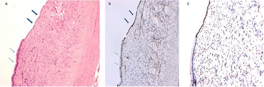 Retroperitoneal mucinous cystadenoma in a 32-year old woman presenting with chronic abdominal pain and a mass in left iliac fossa. (A) The section shows full thickness of the cyst wall, which is lined by a single layer of mucinous epithelium (thin arrows) alternating with attenuated mesothelial cells (thick arrows) (hematoxylin & eosin stain, ×100 magnification). (B) Immunochemistry for calretinin highlights the mesothelial lining (thick arrows) and is negative in the mucinous epithelium (thin arrows) (calretinin stain, ×100 magnification). (C) Immunochemistry showing nuclear positivity for oestrogen receptor in the mesothelial lining and stromal cells (oestrogen receptor stain, ×100 magnification).