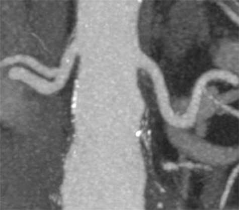 Pre-implant planning CTA showing unhealthy infrarenal aortic neck.
