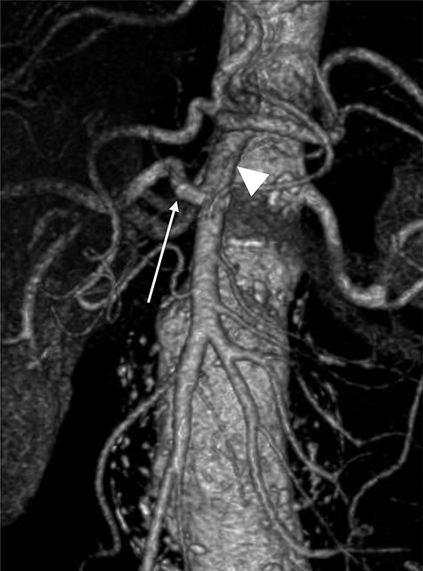Pre-operative CTA showing healthy SMA (arrowhead) with RRHA (arrow).