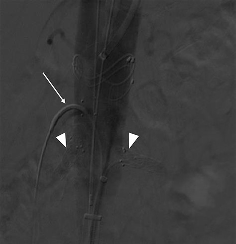 Mid-implantation angiogram showing both renal stents deployed (arrowheads) and SMA cannulated (arrow).