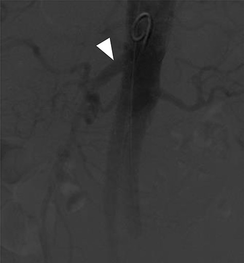 Completion angiogram showing good filling of proximal SMA (arrowhead), renal arteries and common iliac arteries.