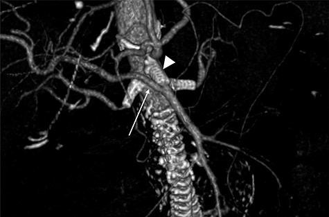 Follow-up CTA showing all visceral stents patent and RRHA (arrow) from SMA (arrowhead).