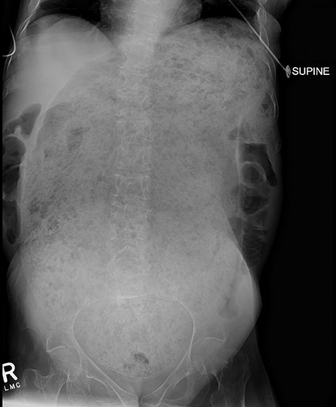 Demonstrates massive megarectum secondary to large stool burden in context of chronic constipation.