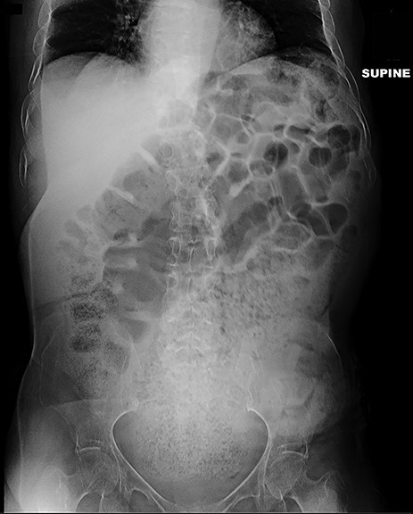 Plain film 2 weeks post-operatively shows significant reduction in stool burden and rectal dilation.