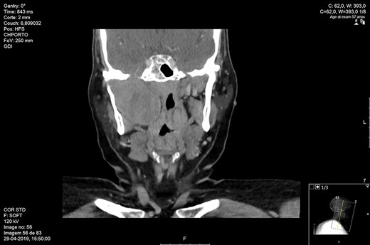 Maxillofacial coronal CT. Right parapharyngeal mass with 54 mm of craniocaudal dimension and 51 mm of transversal dimension.
