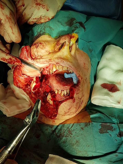 Intraoperative removal of the mass. Transcervical approach with lip-split and mandibulotomy.