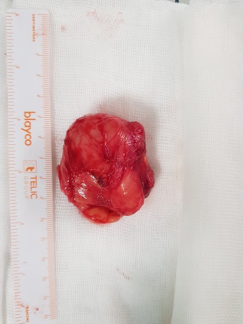 Surgical specimen removed.