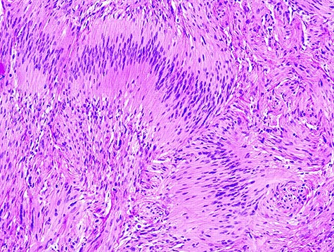Typical spindle cells of schwannoma with hipo and hyper cellular areas.
