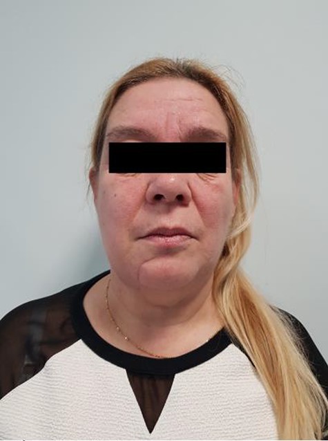 Frontal view with 4 months post-operative.