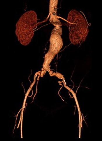 3D reconstruction CT scan of the AAA.