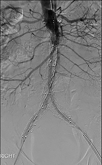 Post-EVAR angiogram showing acute thrombosis of the right limb and subtotal thrombosis of the left limb and trunk.