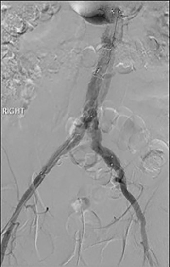 Post-lysis CT scanning showing fully re-canalized aorto-iliac system.