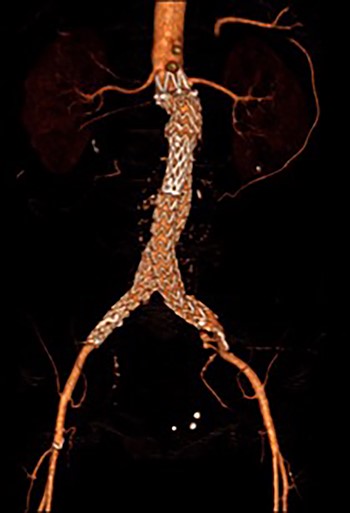 3D reconstruction CT scan, at 6-week interval from index procedure.