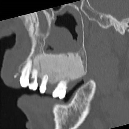 Sagittal section of CT image showing the maxillary bone with a ground glass appearance in distal regions from #24 part and bone resorption around #25 and #26.