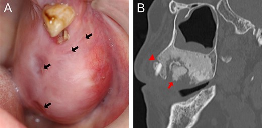 (A) Intraoral photograph showing gingival fistulas in #25 and #26 extraction sites (arrows). (B) Sagittal section of CT image showing separated sequestrums in the left maxilla (arrow) and bone resorption in the periapical area of #24 (arrowhead).