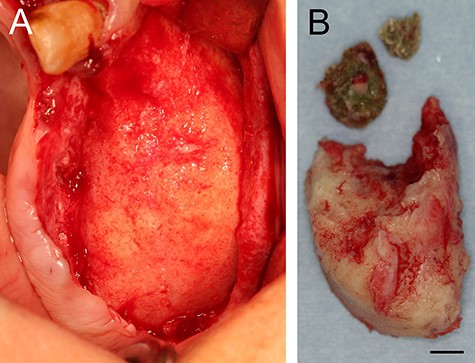 (A) Intraoral photograph showing a resected area. (B) Surgical specimens: separated sequestrums and resected FD bone (scale bar: 5 mm).