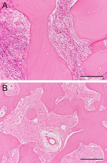 Photomicropraphs showing distinct histopathological findings in surgical specimens (hematoxylin-eosin stain, scale bar: 200 μm). (A) A marginal bone fragment of separated sequestrums showing necrotic bone with typical empty lacunae, surrounded by numerous inflammatory cells, and (B) resection margin showing irregularly shaped trabeculae of woven bone and proliferation of collagen fibers with fibroblasts but no necrotic bone and inflammatory cells.