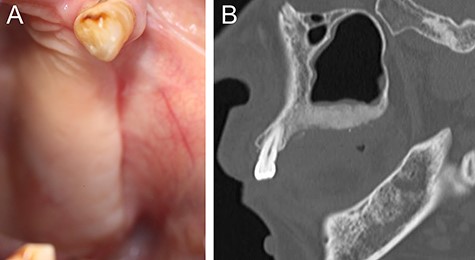(A) Six-month postoperative intraoral photograph showing complete healing of a surgical wound. (B) Sagittal section of CT image showing residual but not recurrently infected FD bone in the left maxilla after surgical resection.