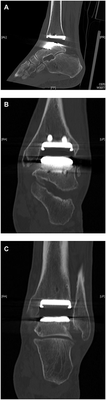 CT demonstration of the poly liner sitting slightly outside of its groove ‘the gap sign’ (A) Lateral view showing ct gap sign (B). AP view showing gap (C). AP view showing poly seating.