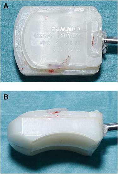 (A, B) Intraoperative pictures of polyethylene liner demonstrating incomplete seating into replacement.