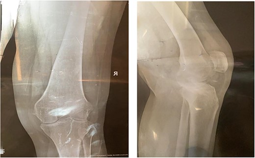 Preoperative X-ray of the knee before the primary operation showing severe osteoarthritis changes.