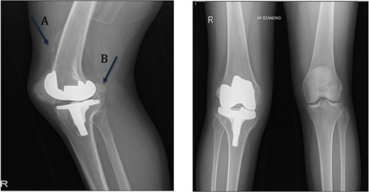 Preoperative standing X-ray showing heterotopic ossification around the prosthesis with preserved knee joint. (A) Heterotopic bone extending proximally on the anterior surface of the femur. (B) Posterior heterotopic bone fusing the knee joint. Careful removal with osteotomes and bone curettes was necessary to remove the old implants.