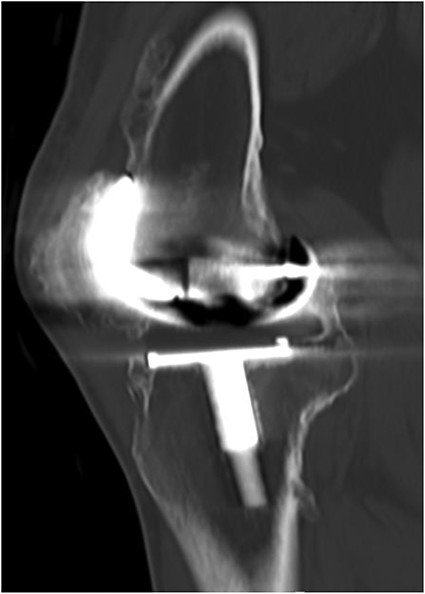 CT demonstrated extensive heterotopic ossification involving the popliteal fossa, the anterior surface of the patella and at the distal third of anterior femur extending to the level of the knee-replacement prosthesis. There was no evidence of implant looseness or alignment deformity and there was no evidence of progressive ossification.