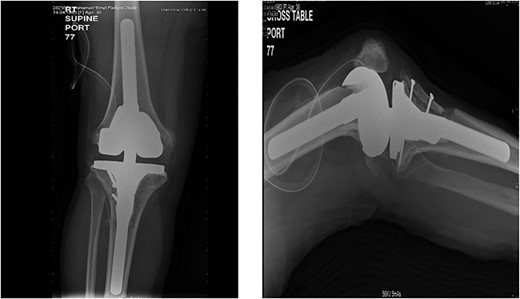 Intraoperative image intensifier demonstrated position of the implant, screw and the osteotomy site.