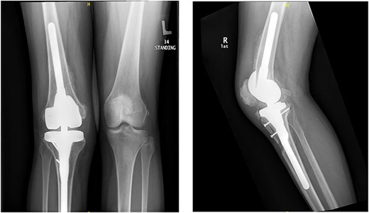 Knee X-rays at 4 months visit continued to show no new HO formation, and continuation of healing of the osteotomy.