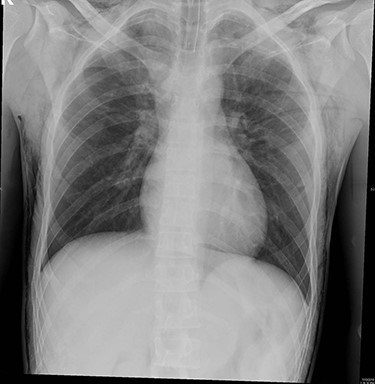 Bilateral surgical emphysema at subcutaneous tissues of the chest and root of the neck was found.